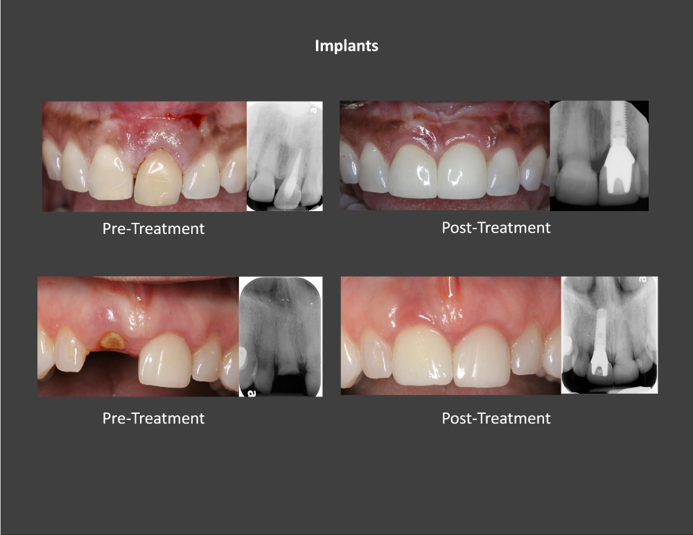 Sky Ridge Periodontics and Implants Smile Gallery